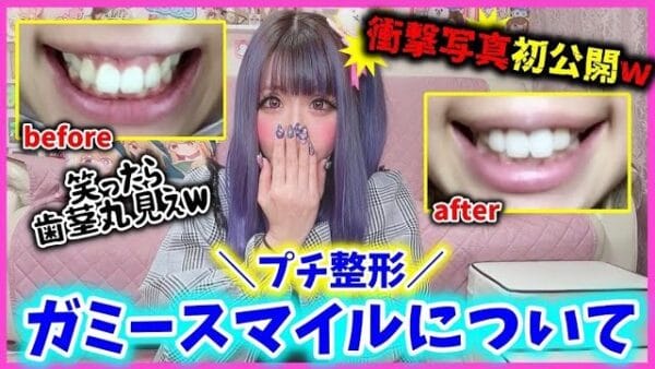 ちいめろ、ガミースマイルのプチ整形・ボトックスを語る！「色んなクリニックに行ってみて！」と情報収集の大切さを呼びかけ